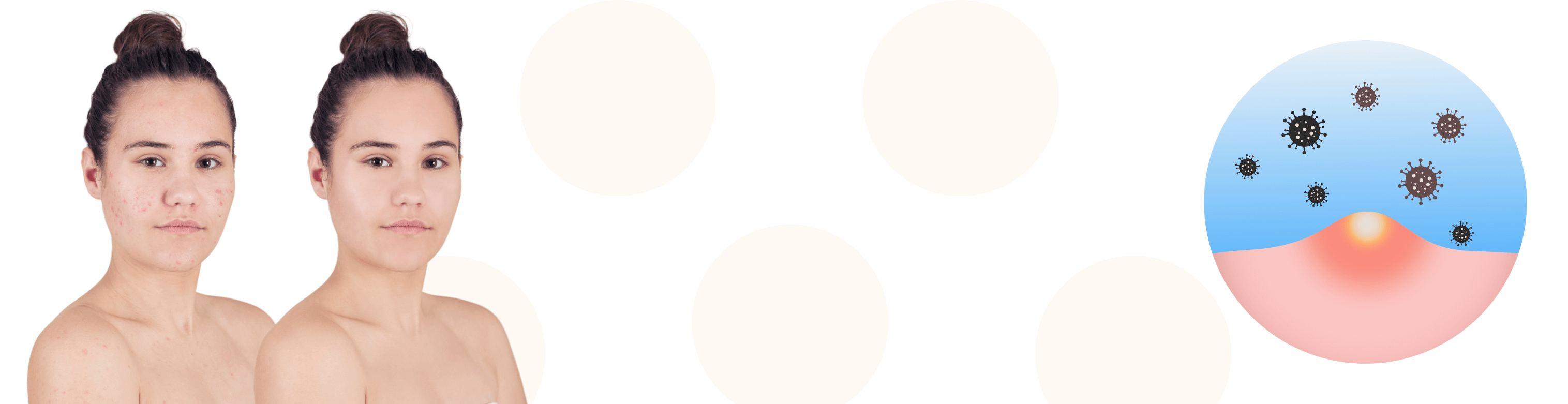 Understanding the Root Causes of Acne: More Than Just Skincare